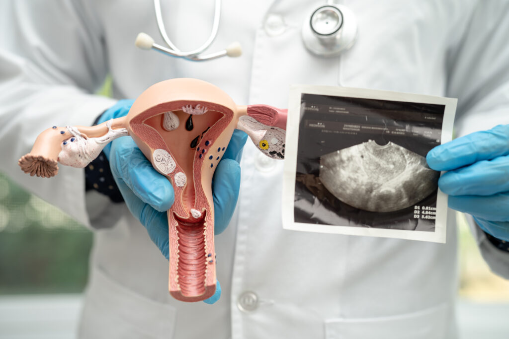 What Is a Subserosal Fibroid and How Is It Treated?
